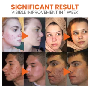 Oveallgo™ Carrot Pore Purifying Bubble Mask