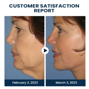 Oveallgo™ EMSPulse V-Face Sculpting Device