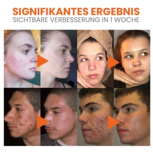 Oveallgo™ Karotte Porenreinigende Blasenmaske