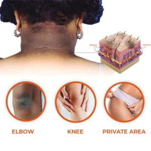 Oveallgo™ NigriClear Acanthosis Nigricans Therapy Oil