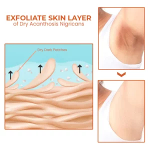 Oveallgo™ NigriClear Acanthosis Nigricans Therapy Oil