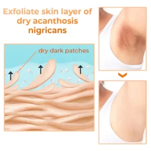 RE RCCRO-POURA™ Acanthosis Nigricans Therapy Serum