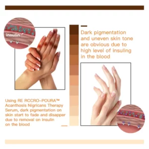 RE RCCRO-POURA™ Acanthosis Nigricans Therapy Serum