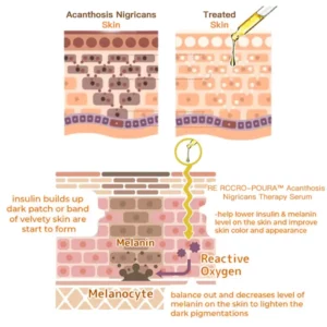 RE RCCRO-POURA™ Acanthosis Nigricans Therapy Serum