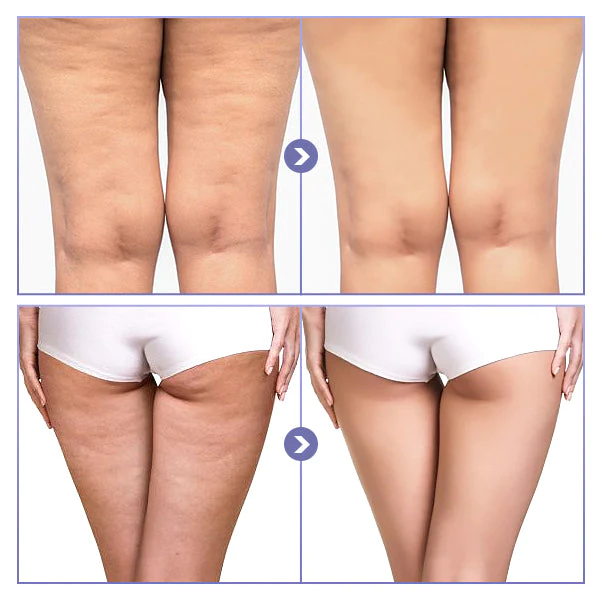 SKINNIER Tightening & Cellulite-Reducing Thigh Patch - Image 5