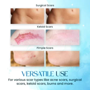 ScarErase™ UV Phototherapy Scar Removal Pen