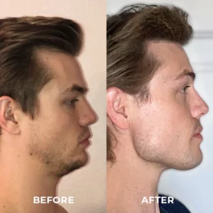 ShapeZ™ Jawline Exerciser