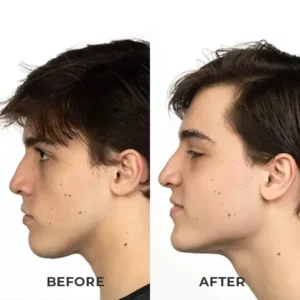 ShapeZ™ Jawline Exerciser