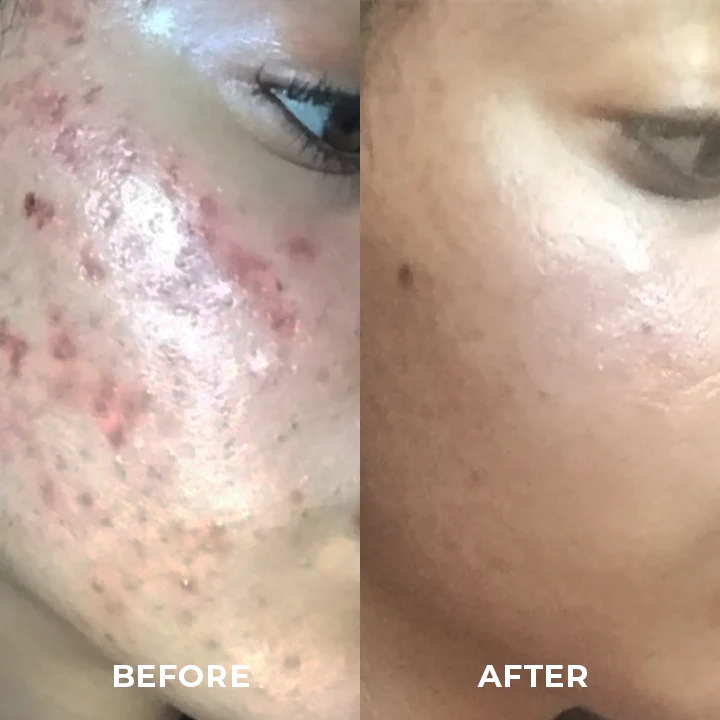 Skinetic™ Single-Packaged Eggplants Mud Mask