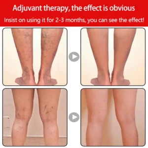 Varicose Veins Edema Care Socks