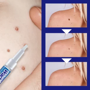 WartFREE™ Common & Plantar Wart Remover