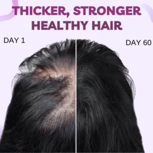 ZeroFall™ Hair Growth Minoxidil Foam