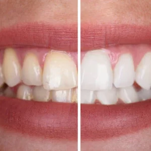 v34™ Dental Color Corrector