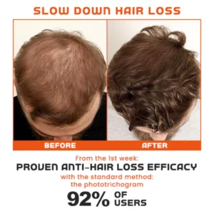 ACT Minoxi Roll-On Hair Treatment