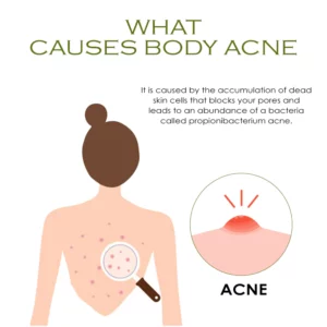 ATTDX BodyAcne Removal TeaTree Cream