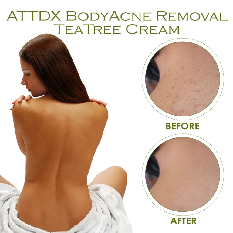 Crema d'arbre de te per eliminar l'acne corporal ATTDX