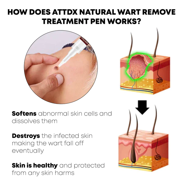 Ošetrovacie pero ATTDX Natural WartRemover