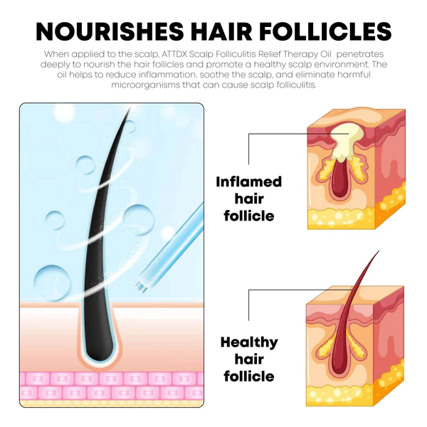 Óleo para terapia de alívio de foliculite do couro cabeludo ATTDX