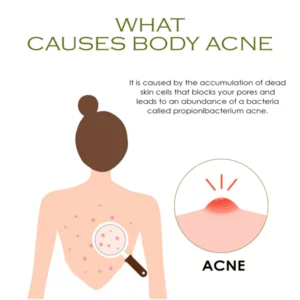 BodyAcne Removal TeaTree Cream