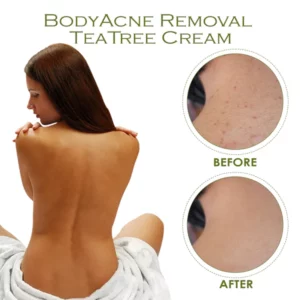 BodyAcne Removal TeaTree Cream