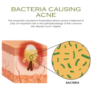 BodyAcne Removal TeaTree Cream