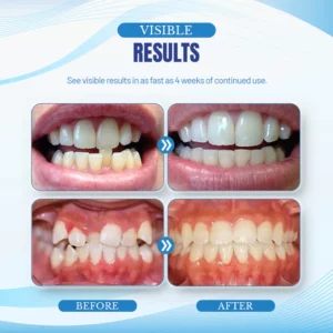 CC™ Jaw Alignment Brace