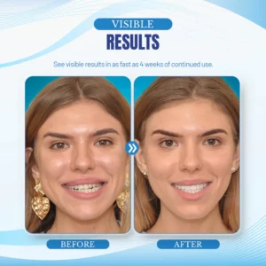 CC™ Jaw Alignment Brace