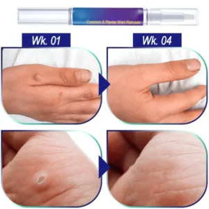 Common & Plantar Wart Remover