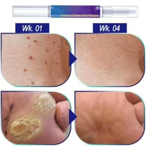 Common & Plantar Wart Remover