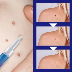 Common & Plantar Wart Remover