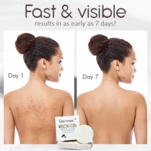 Dermax™ Back Acne Treatment Soap