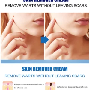 EELHOE™ Clearasil Petechiae Removal Cream