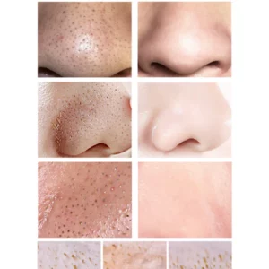 Facial Essence Blackhead Removal Kit