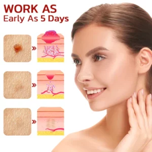 GFOEK™ Tags & Moles Remover