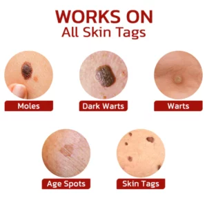 GFOEK™ Tags & Moles Remover