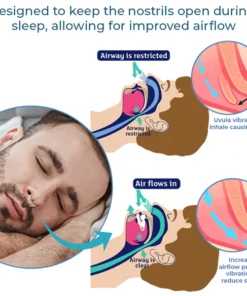 GFOUK™ Schlafapnoe-Prävention Nasenklammer