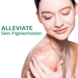 GFOUK™ TreatVitiligo Beruhigende Creme