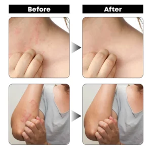 Gutdp™ AntiBacterial Reduce Itchiness Cream