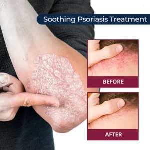 MEDix™ Psoriasis Therapy Spray