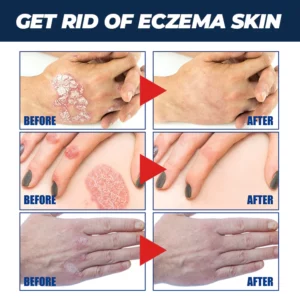 MEDix™ Psoriasis Therapy Spray