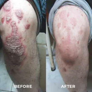 MEDix™ Psoriasis Therapy Spray