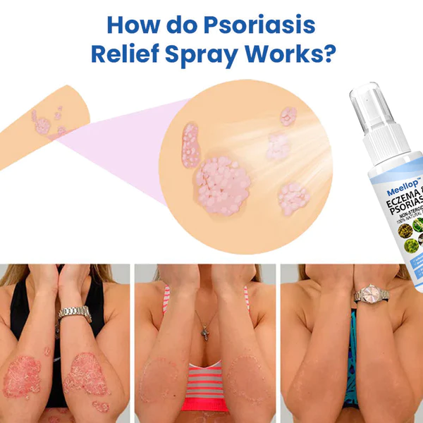 Meelop ™ Herbal Psoriasis Relief Spray