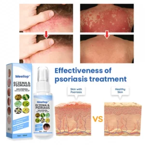 Meellop™ Herbal Psoriasis Relief Spray
