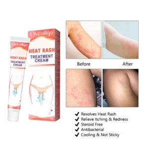Oeallgo™ Heat Rash Treatment Cream