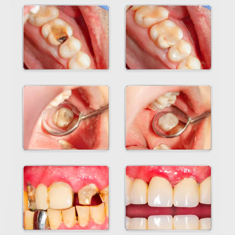 Oraliz™ 虫歯予防ガム健康歯磨き粉