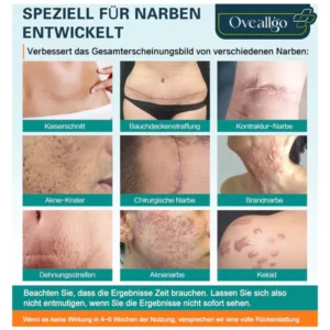 Oveallgo™ LUX Fortgeschrittenes Spray zur Narbenentfernung