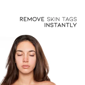 Oveallgo™ WipeOff Tags & Moles Remover