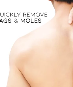 Oveallgo™ WipeOff Tags & Moles Remover