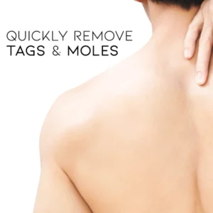 Oveallgo™ WipeOff Tags & Moles Remover