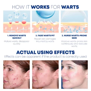 PURE WartRemover Organic Cream